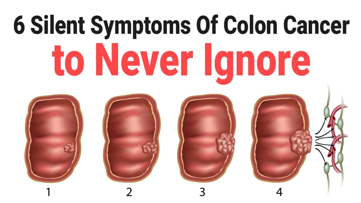 Colon Cancer Stool Shape